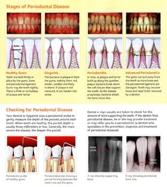 Periodontal Disease Stages — Tooth Extraction in Wausau, WI