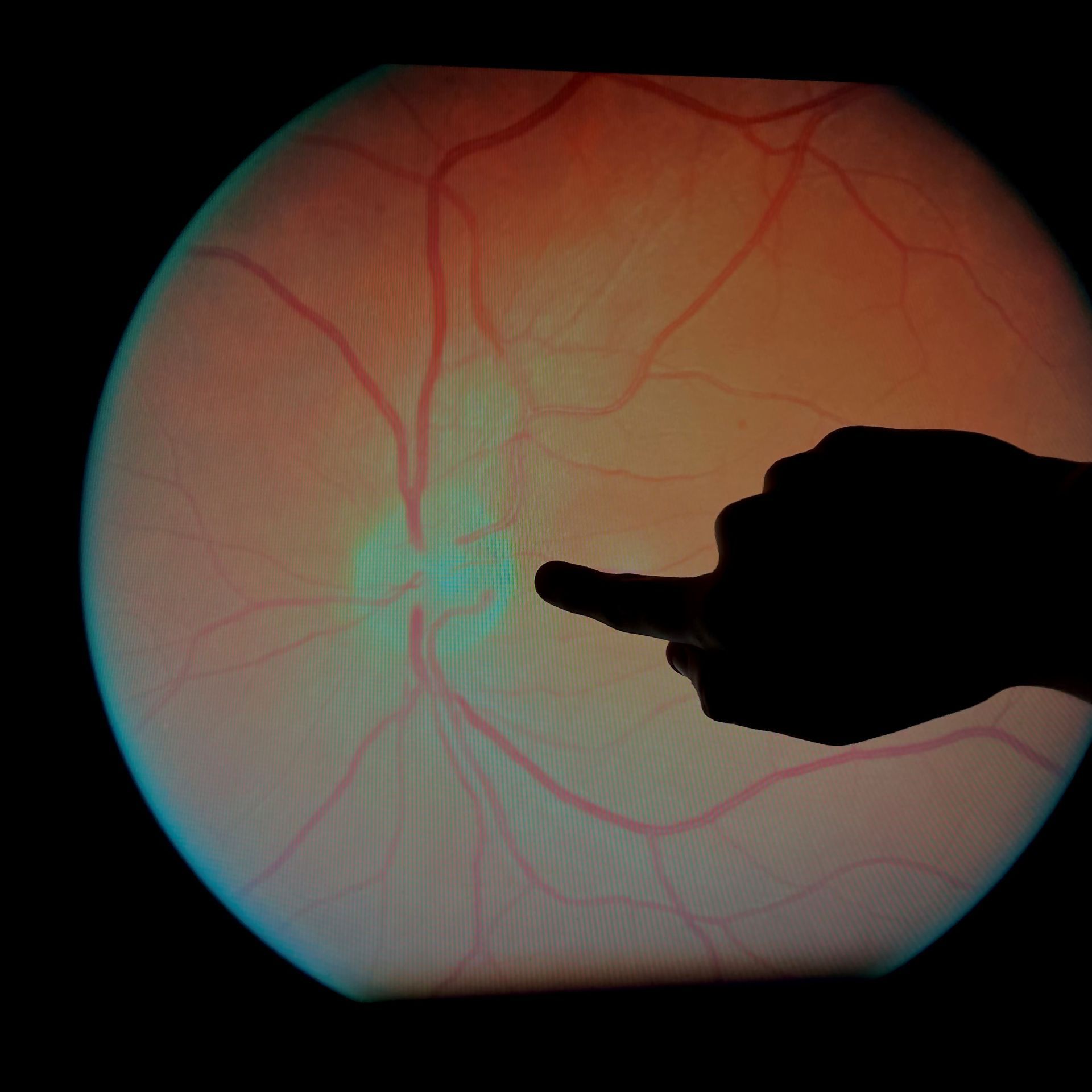 Finger pointing towards the retina photo — Optometrist in Wallsend, NSW