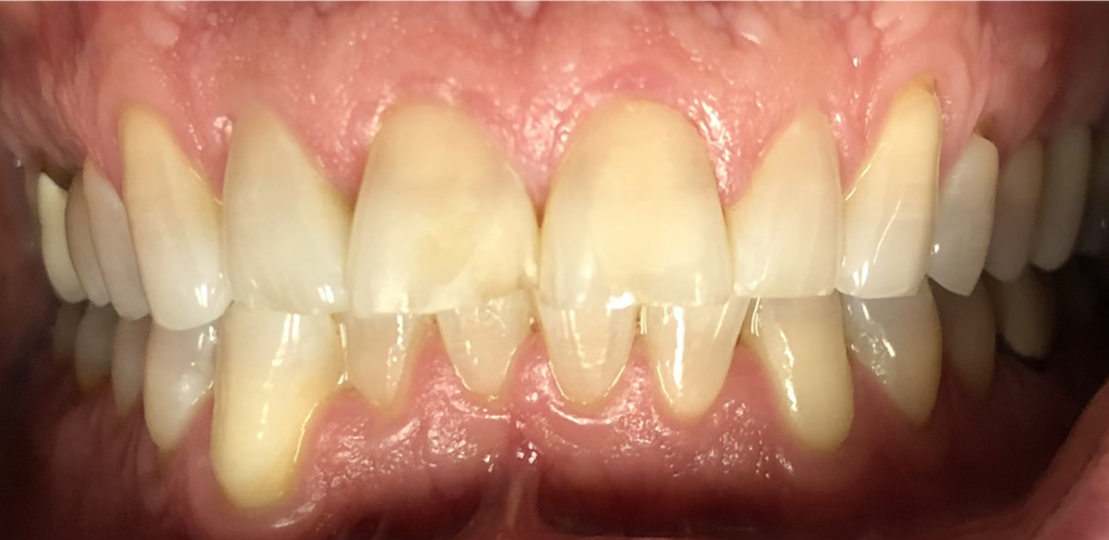 Close-up of teeth, showing yellowing and a gap between the two front teeth.