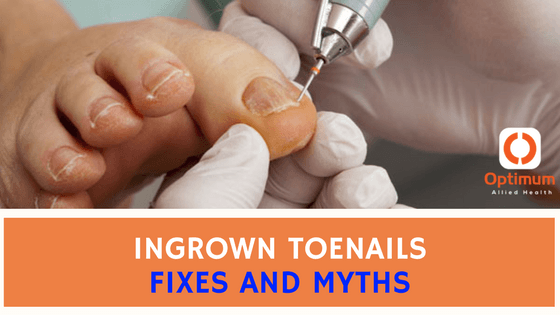 Fixes & Myths About Ingrown Toenails | Optimum Allied Health