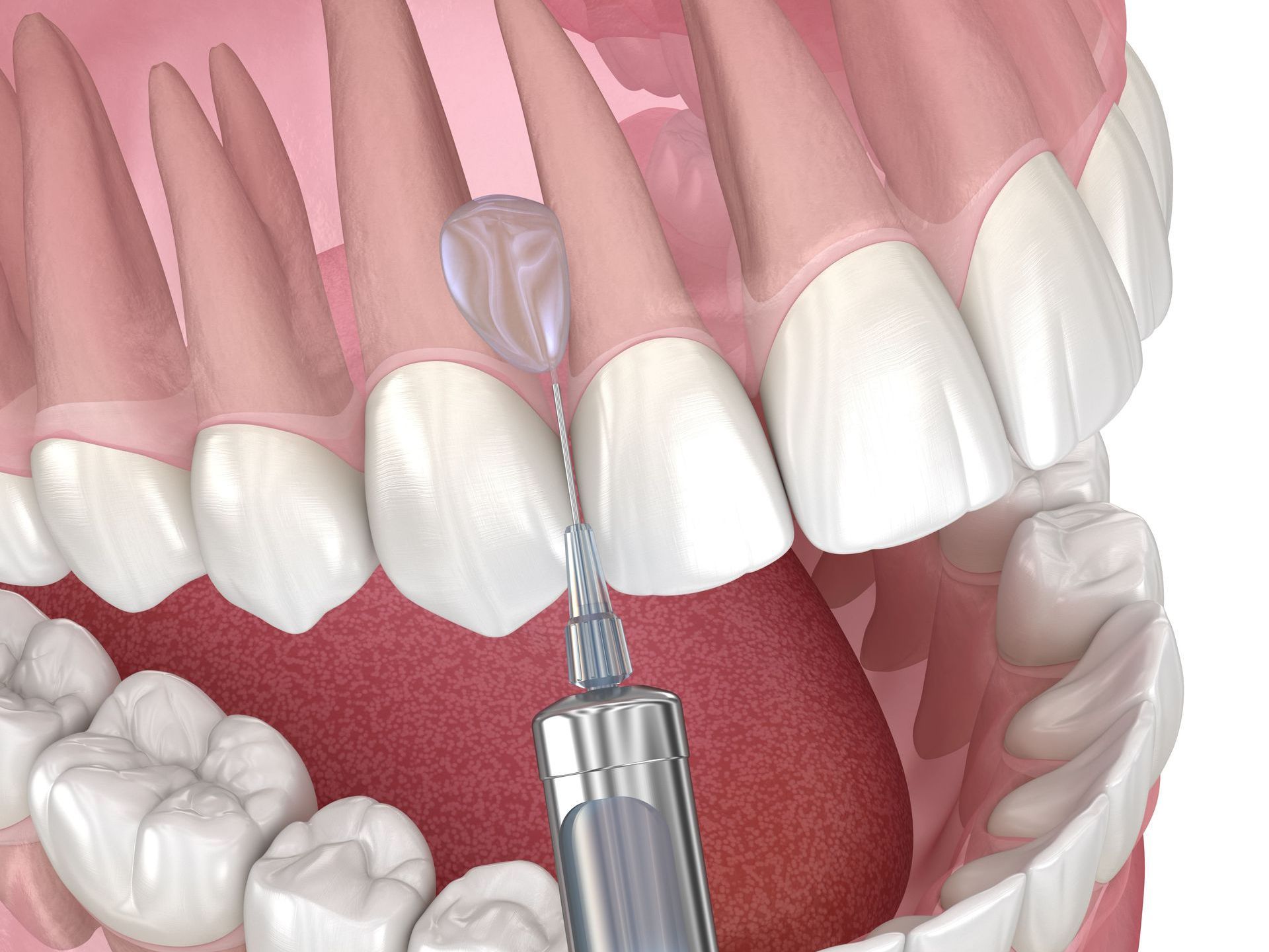 A 3D model of a person's mouth with a syringe in it