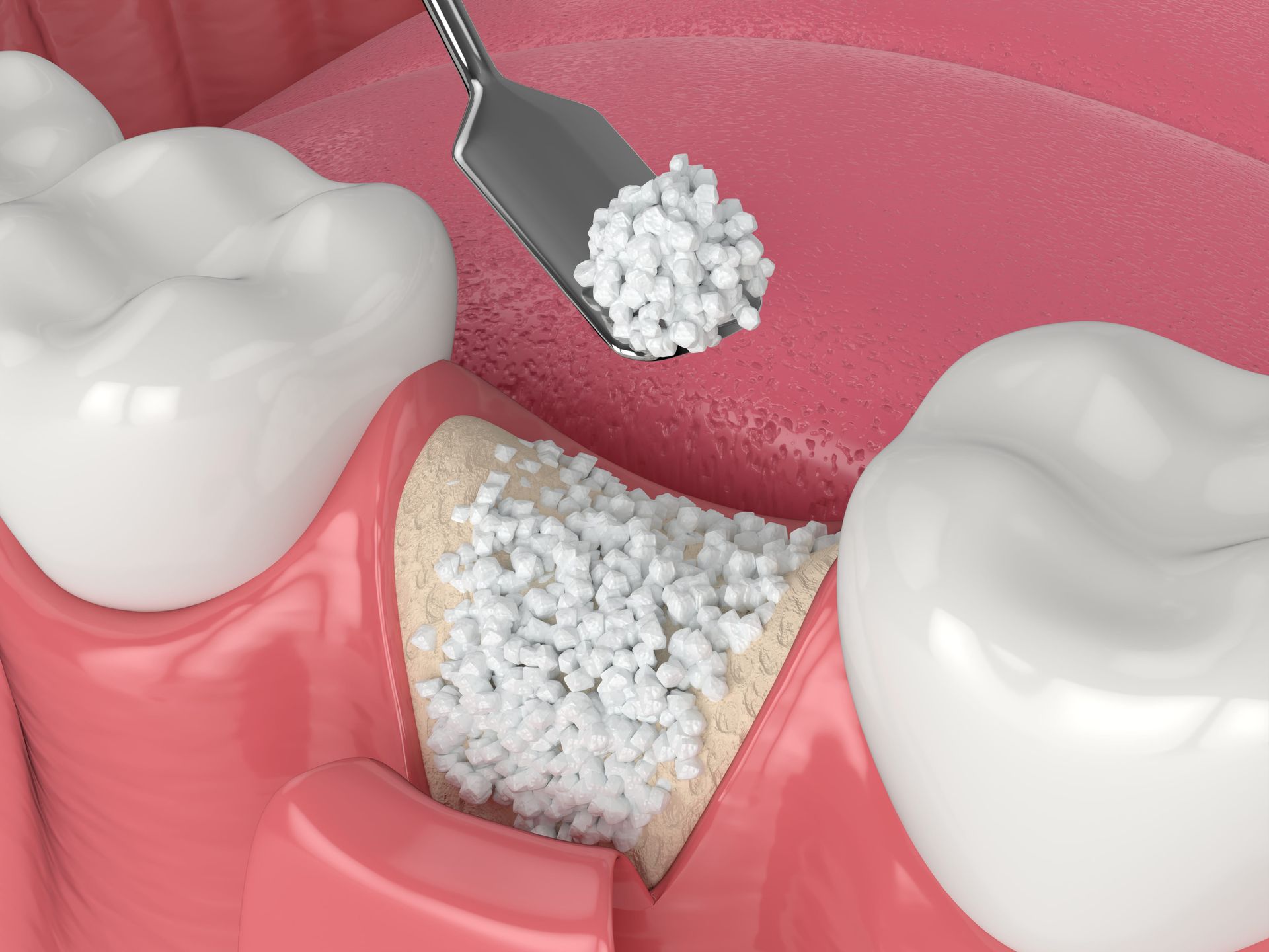 A close up of a tooth with bone grafting material in it