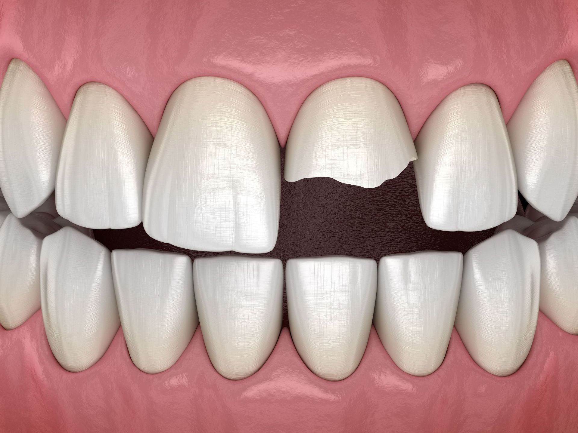 A close up of a person's teeth with a broken tooth