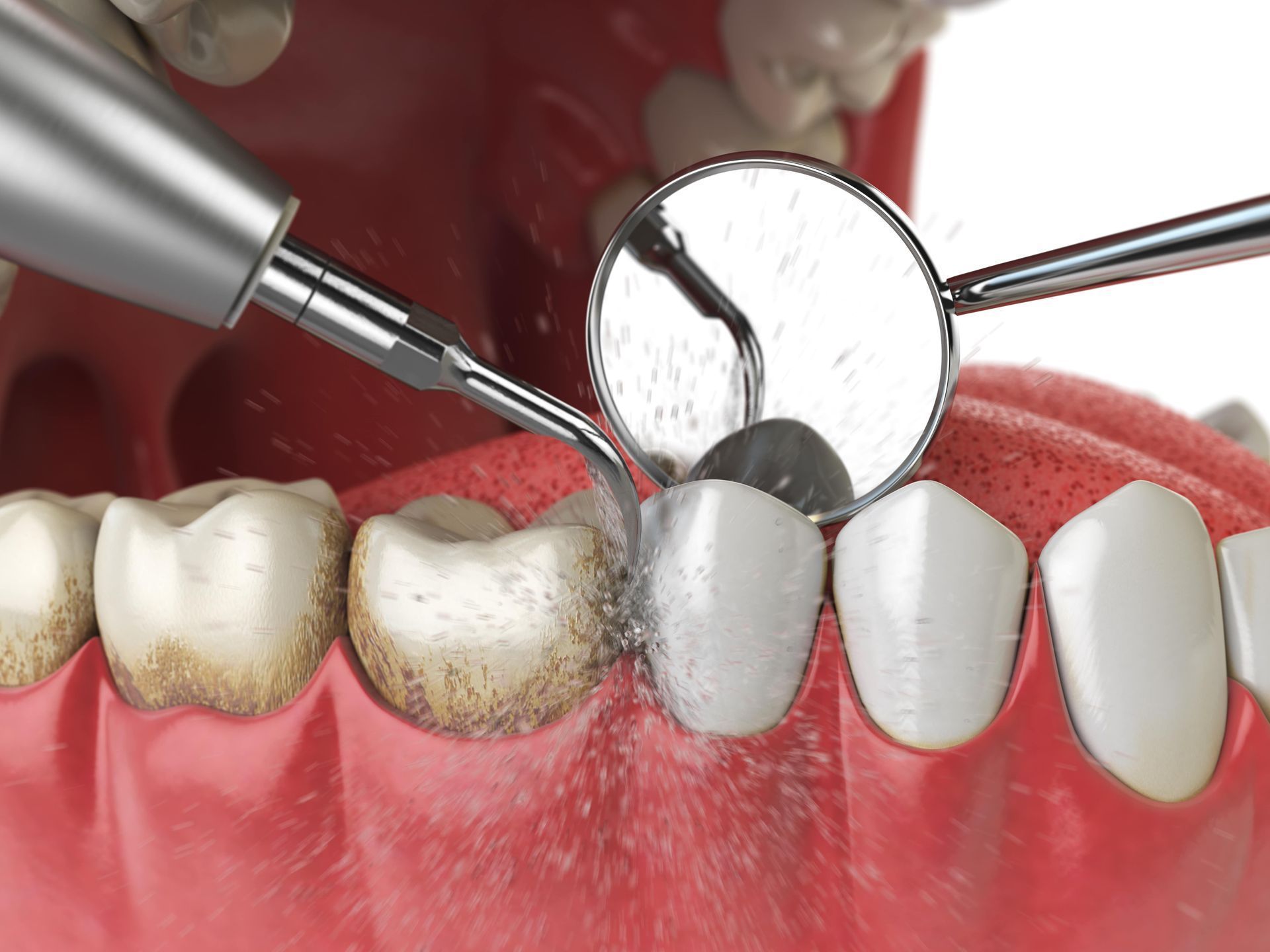 A dentist is cleaning a person's teeth with a mirror