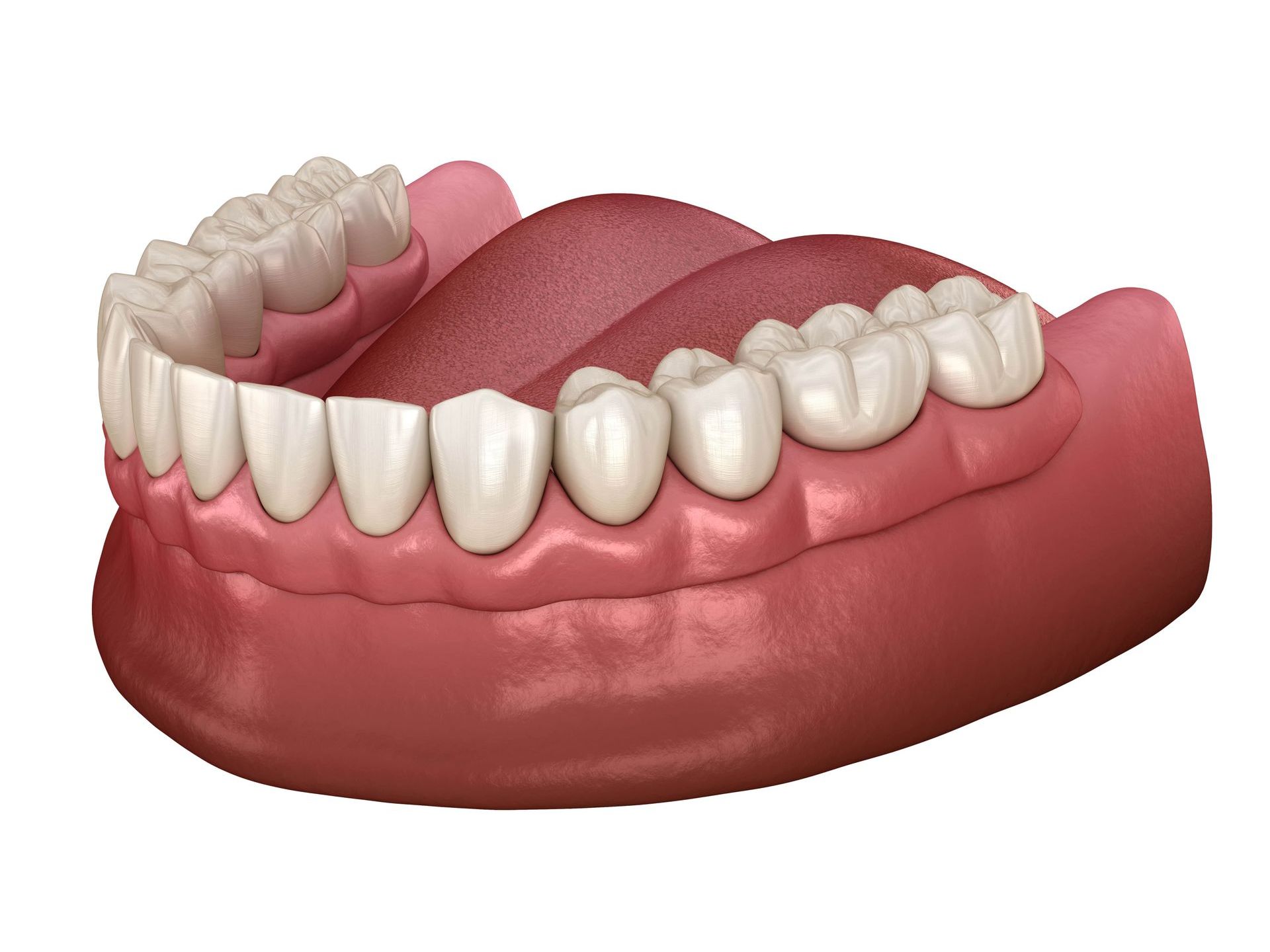 dentures