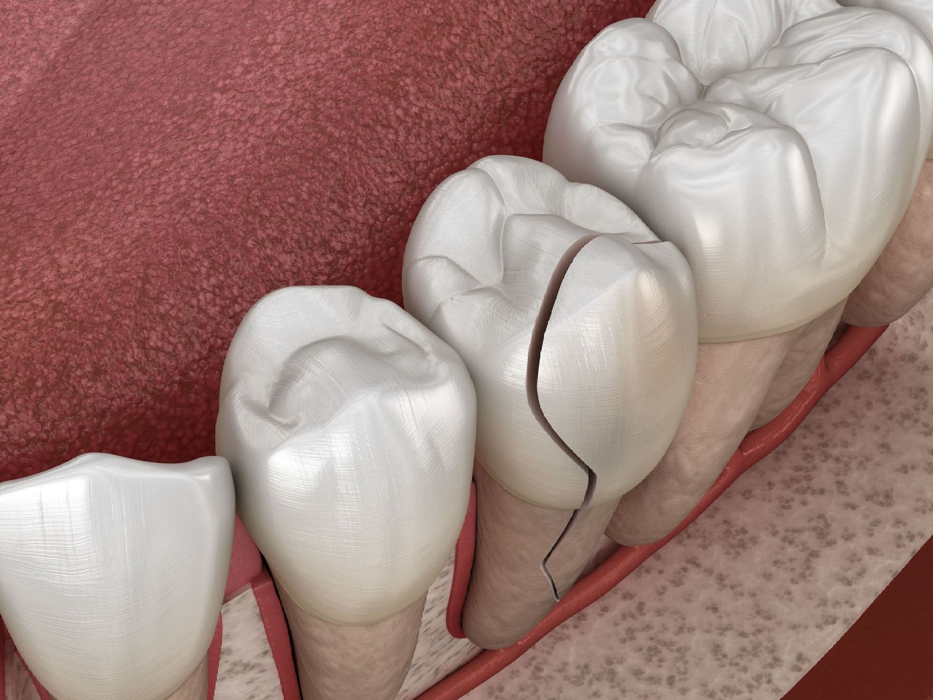 A computer generated image of a row of teeth with a broken tooth