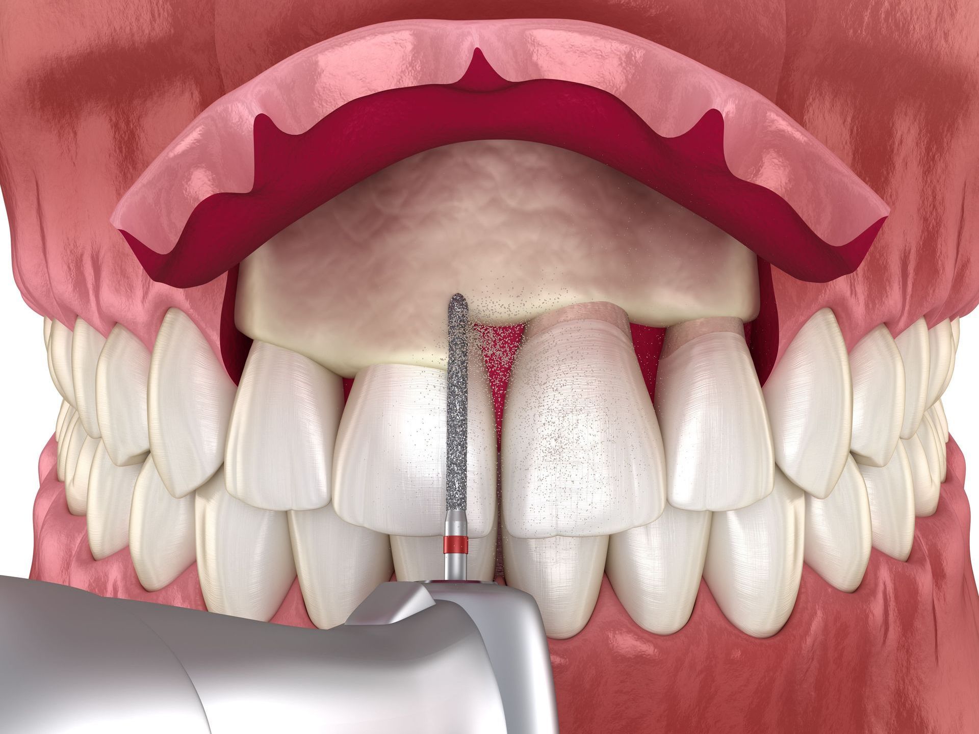 A close up of a person's teeth with a drill in it