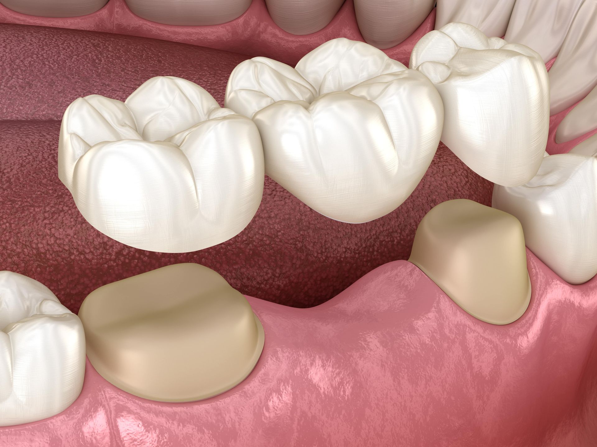 A computer generated image of a dental bridge in a person's mouth