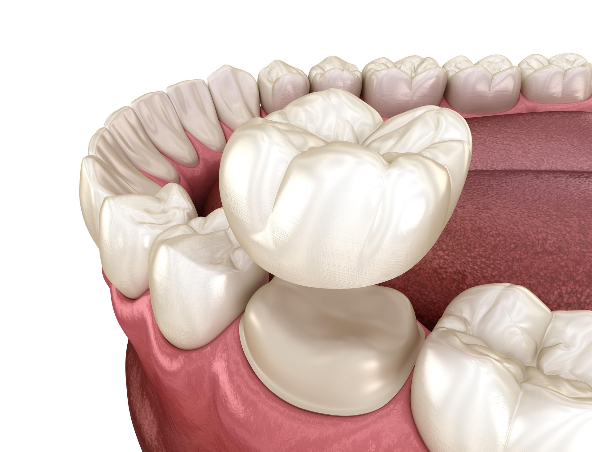 A close up of a tooth with a dental crown on it