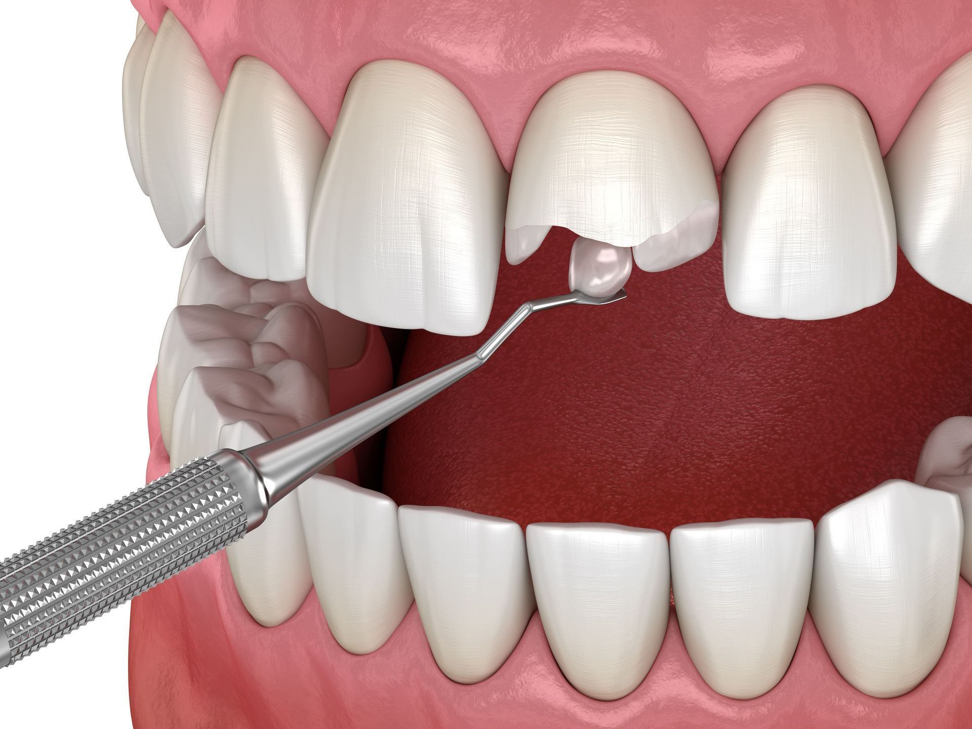 A tooth with a hole in it is being examined by a dentist