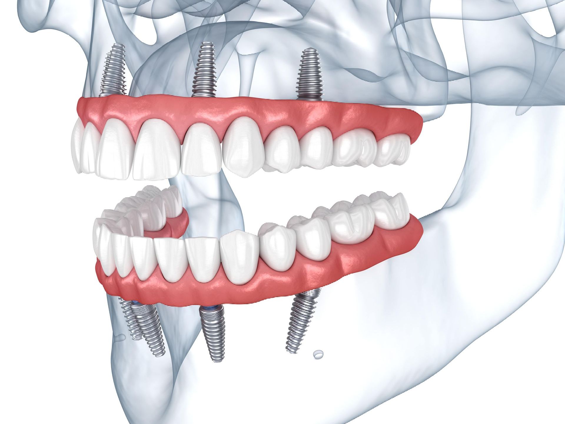 A computer generated image of a person's teeth and skull