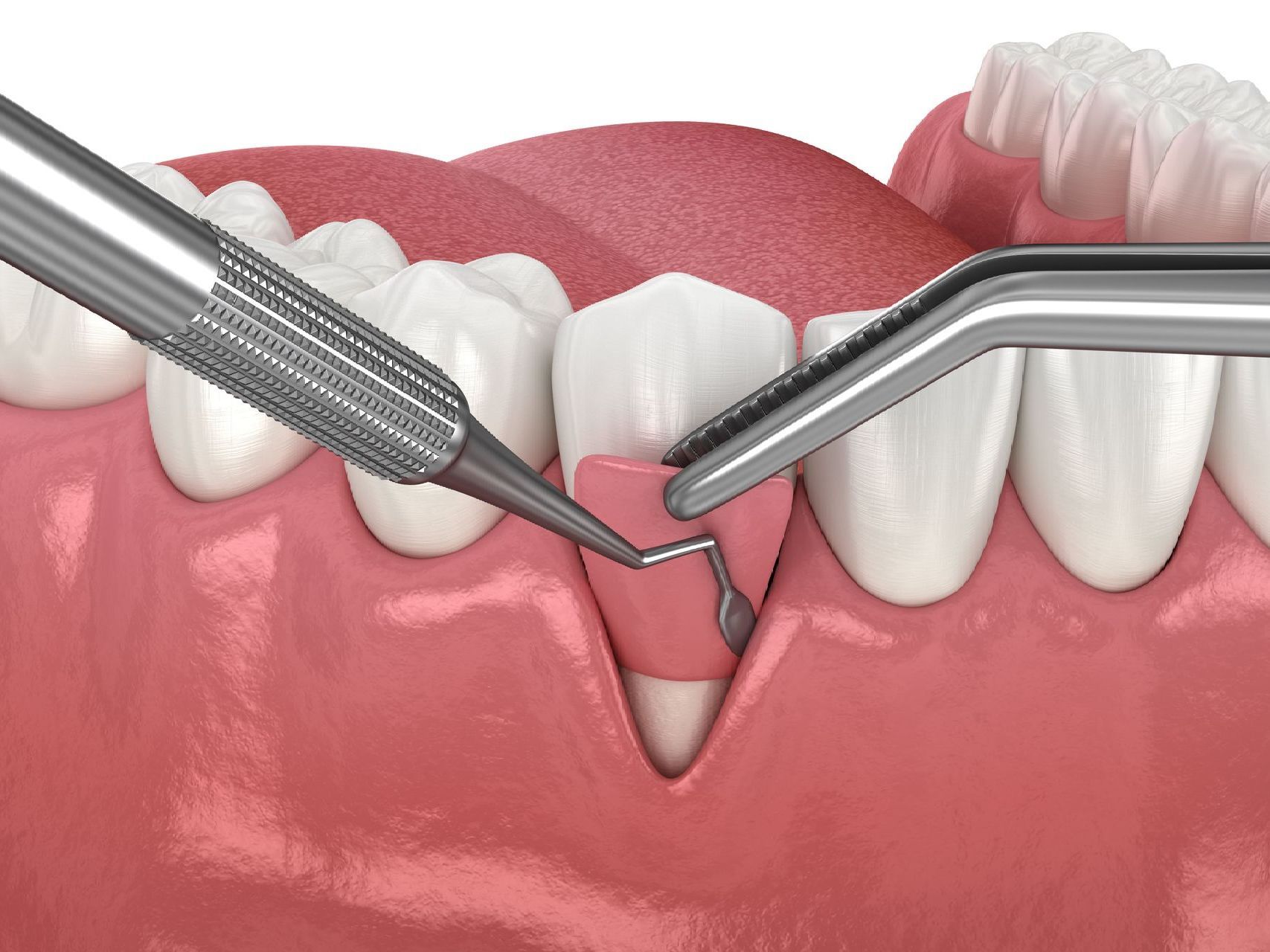 A close up of a tooth receiving a gum graft