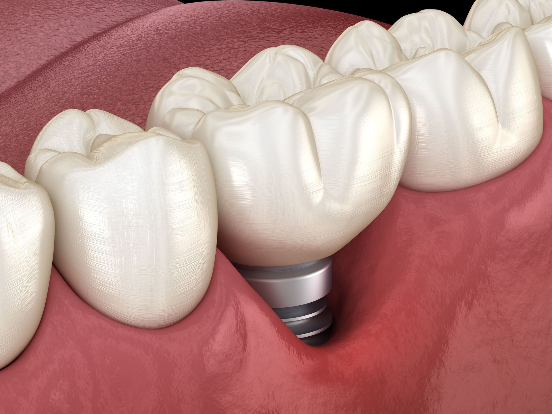 A computer generated image of a dental implant in a row of teeth.