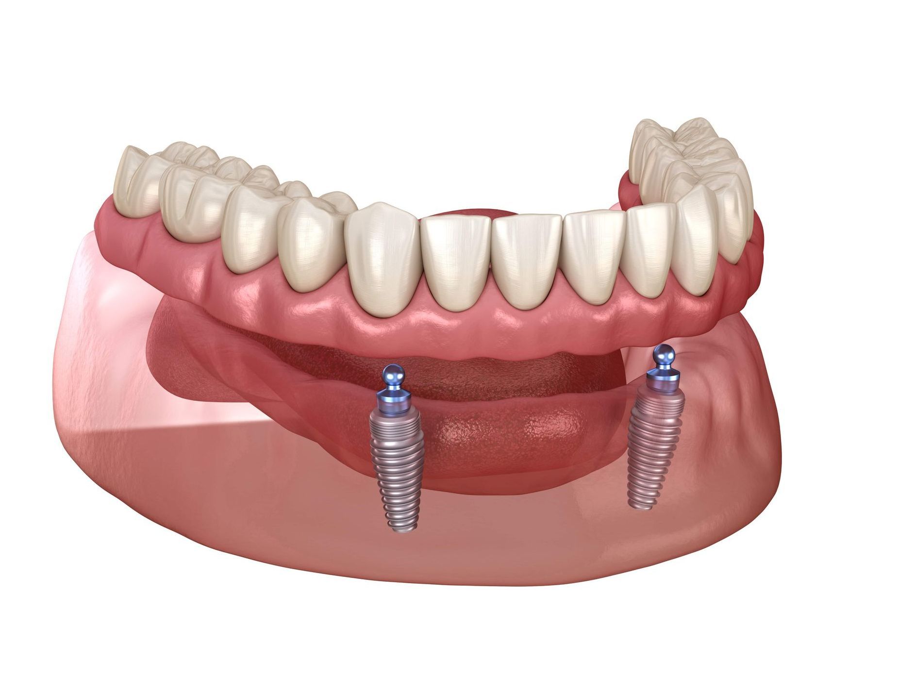 A computer generated image of a denture with two dental implants.