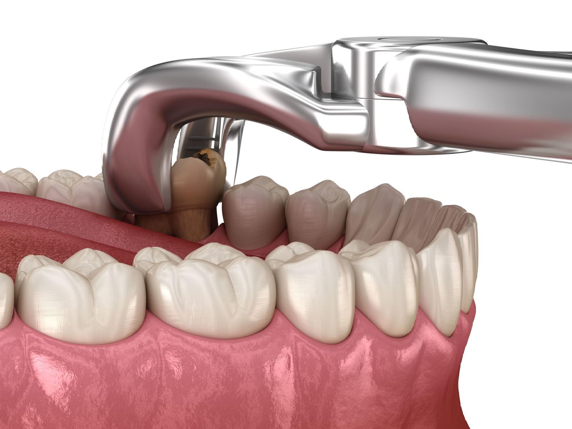 A tooth is being removed from a person's mouth