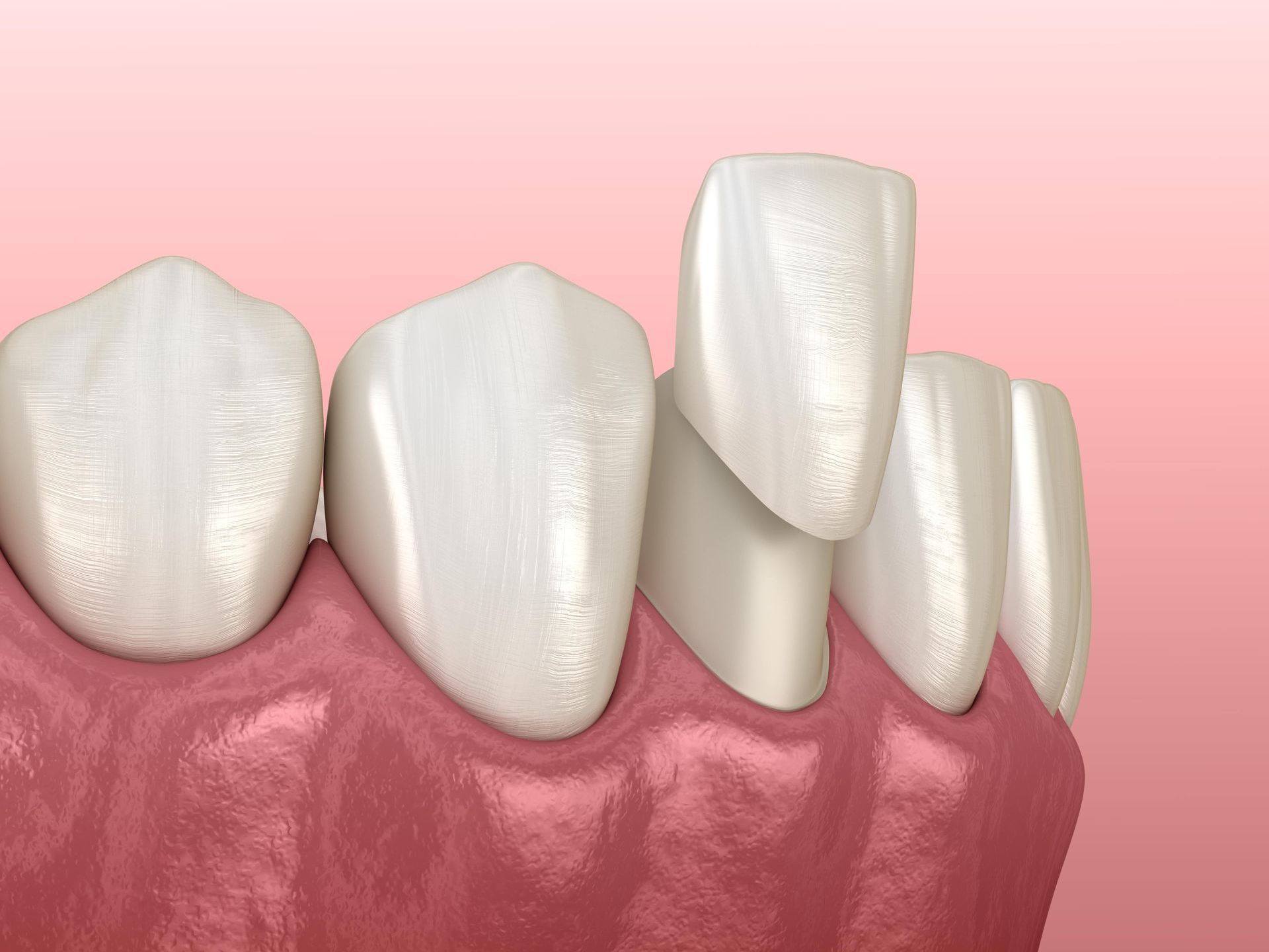 A computer generated image of a person 's teeth with dental veneers