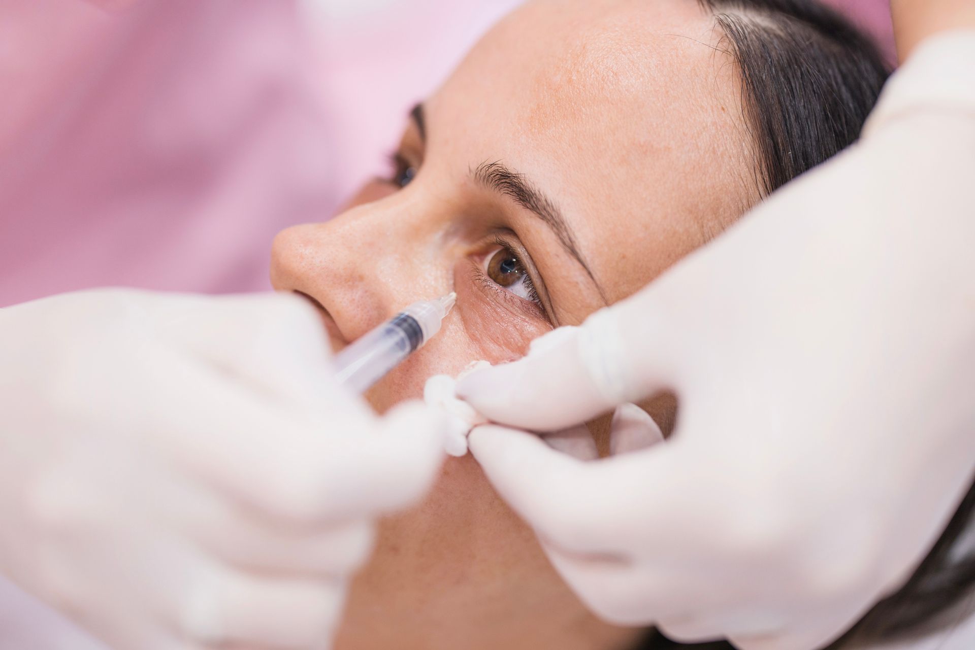Tear trough filler treatment under the eye