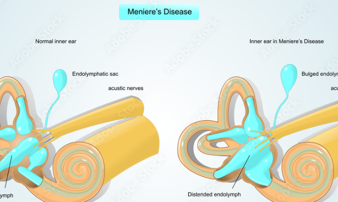 A diagram of a person 's ear showing the stages of meniere 's disease