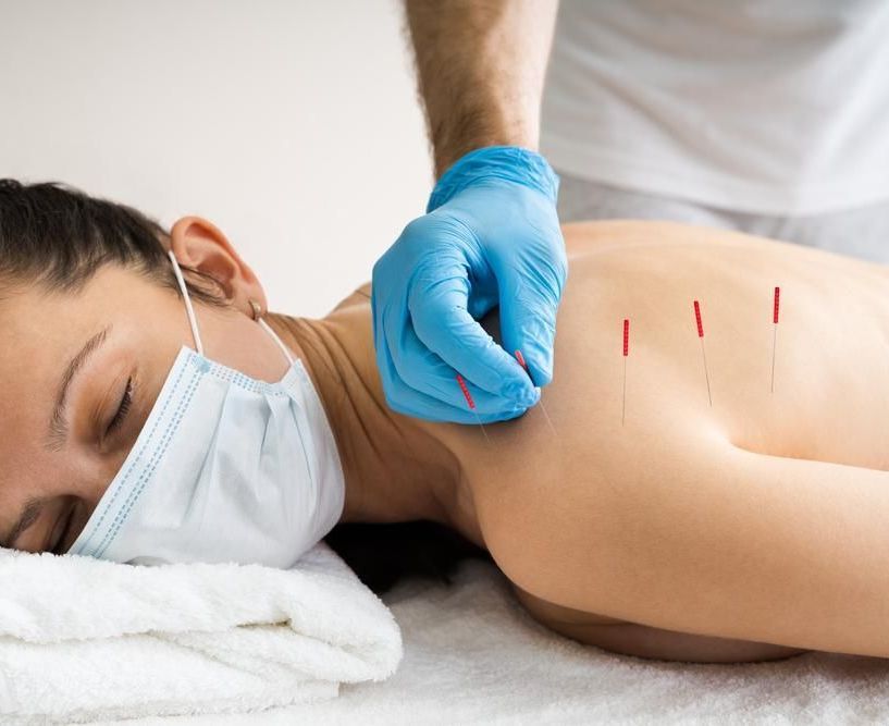 A Woman Wearing A Mask Is Getting Acupuncture On Her Back — Mark Coulton Cardiff Physiotherapy Centre In Cardiff, NSW