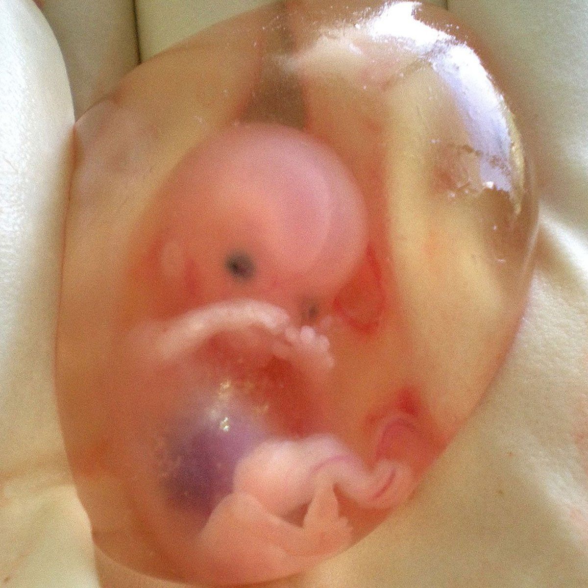 Human Fetus - 10 weeks - Therapeutic Abortion.