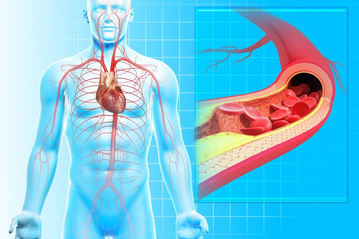 arteria-entupida-clinica-vascullare-cirurgia-vascular-foz-iguacu