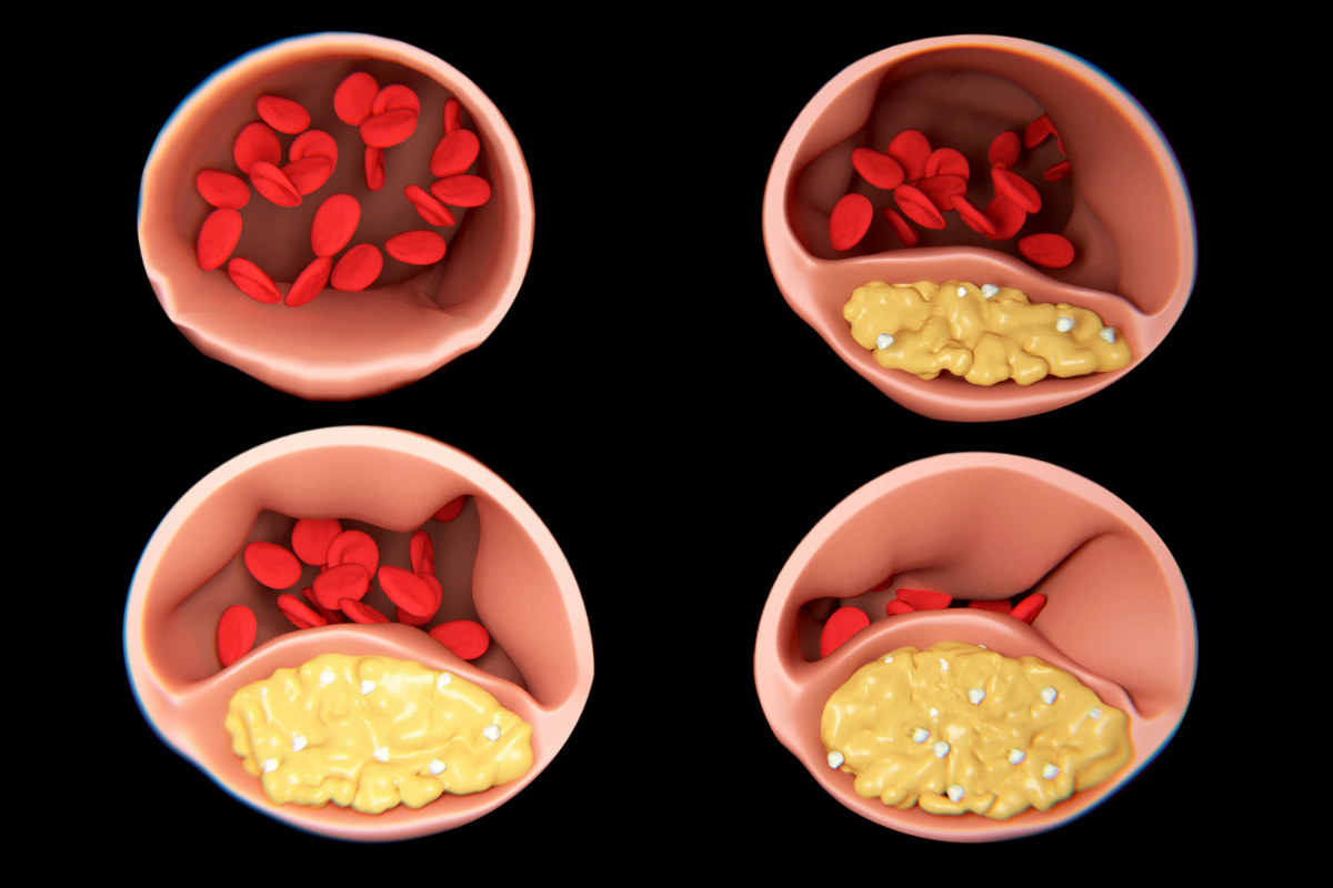 arteria-entupida-clinica-vascullare-medico-vascular-foz-iguacu