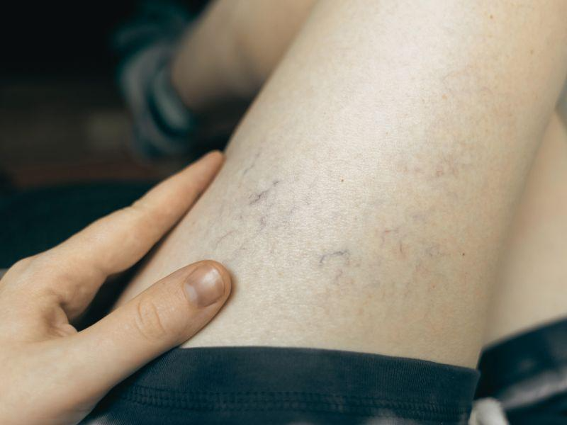 Benefícios do laser transdérmico nas varizes: o que esperar do tratamento?