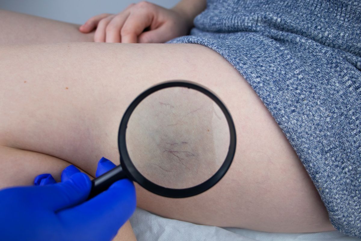 beneficios-tratamento-de-varizes-com-espuma-Vascullare-cirurgia-vascular-foz-do-iguacu