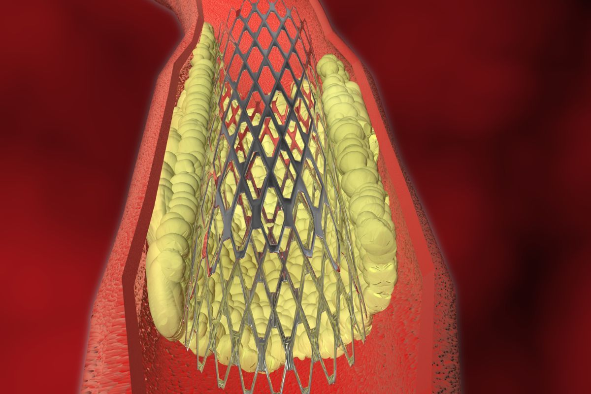 cirurgia-carotida-clinica-vascullare-cirurgiao-vascular-foz-iguacu