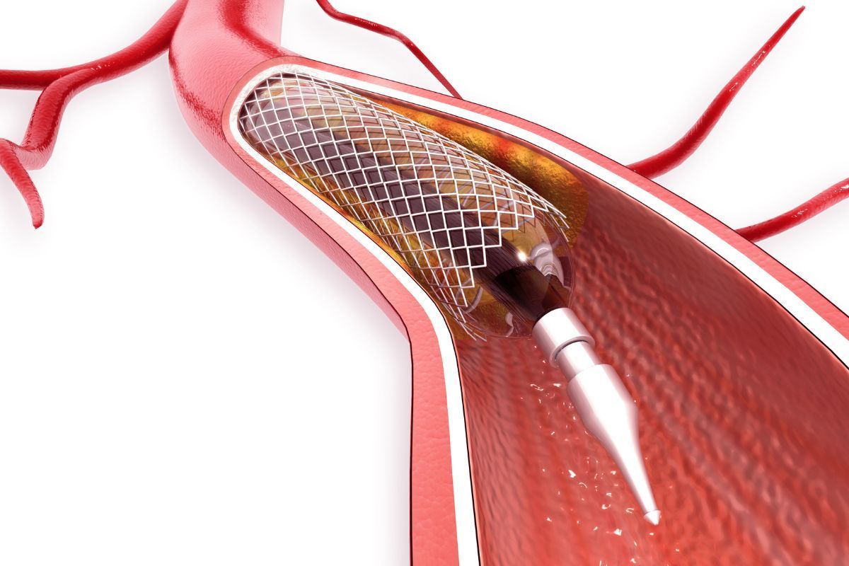 colocacao-stent-vascullare-cirurgia-vascular-foz-do-iguacu