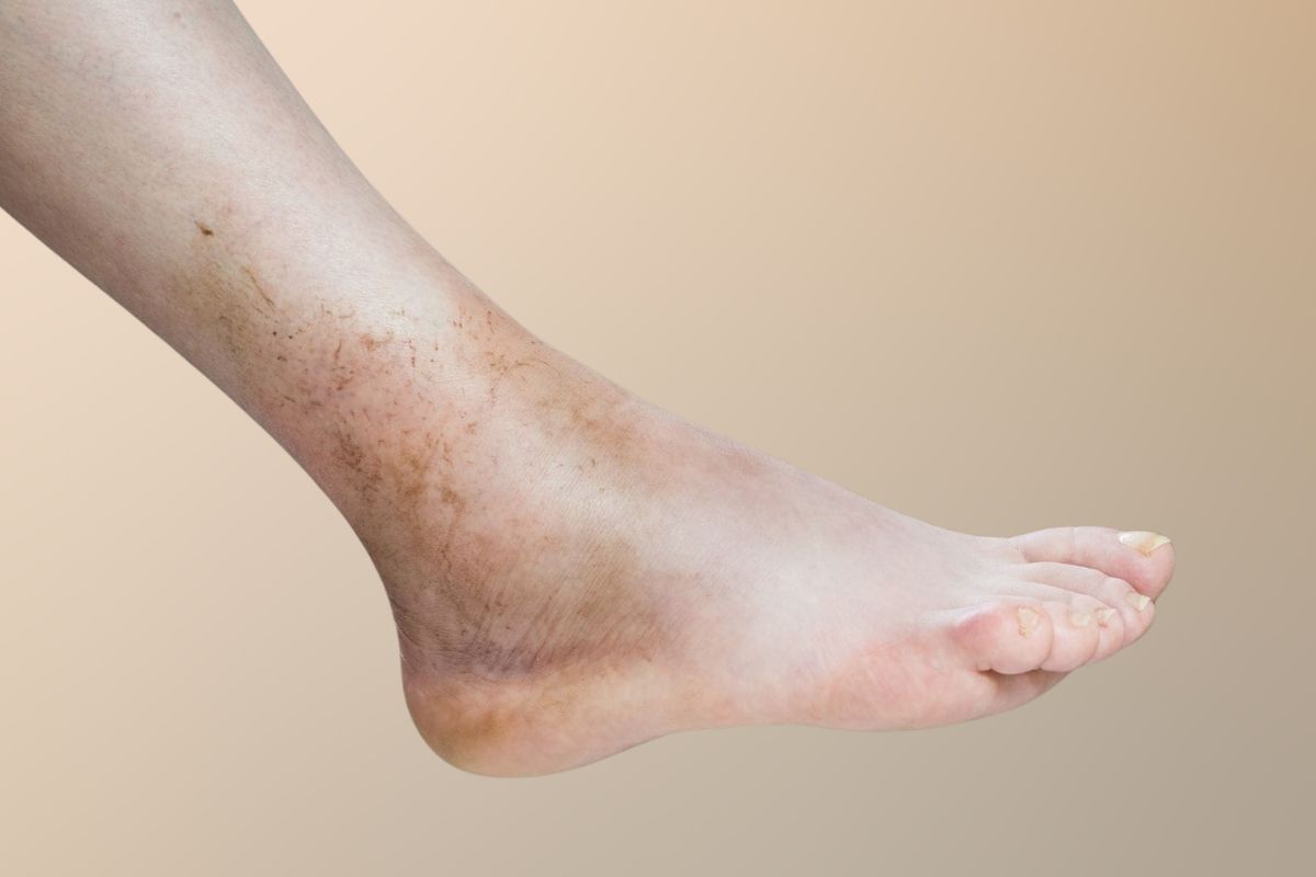 Dermatite ocre e varizes: qual a relação?