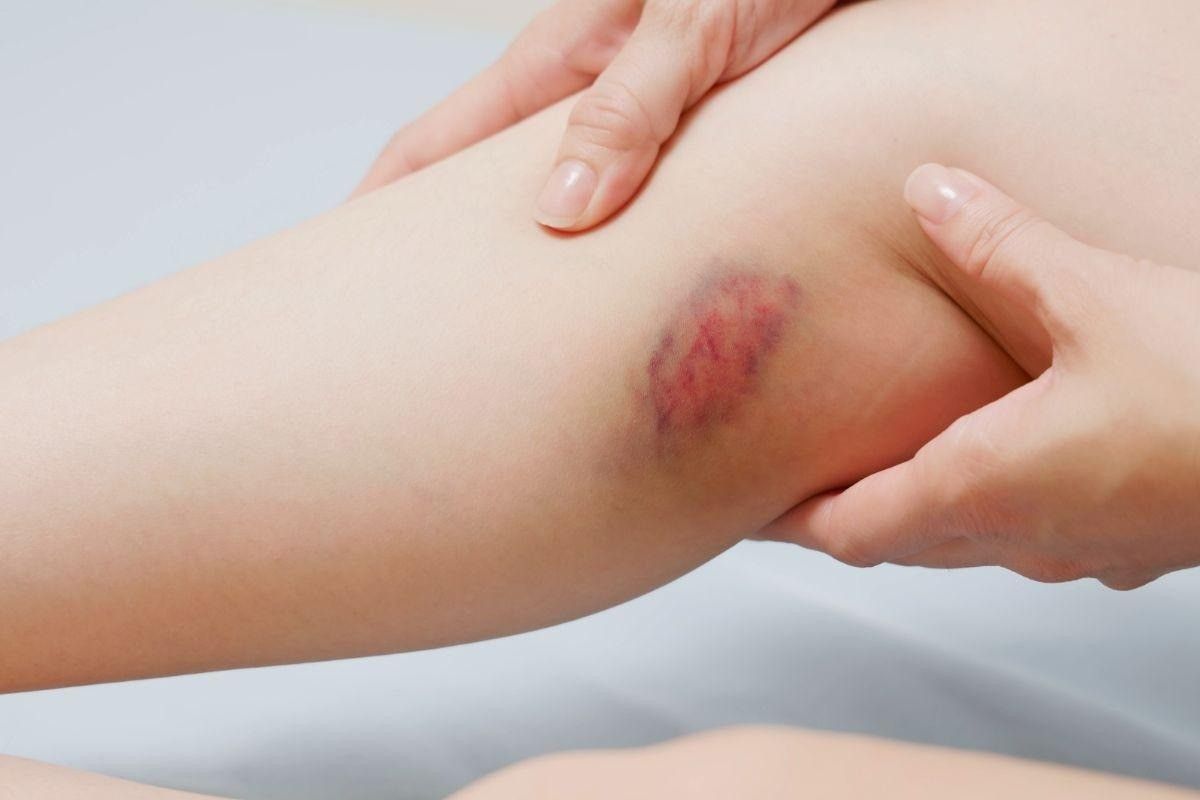 Fragilidade capilar: quais são os sinais e quando procurar o especialista?