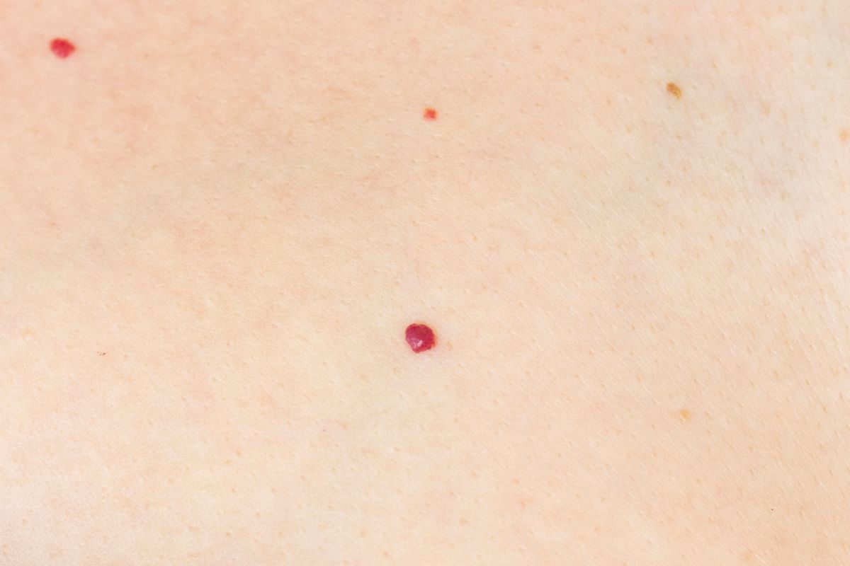 Hemangioma rubi: quando o laser é a melhor opção de tratamento?