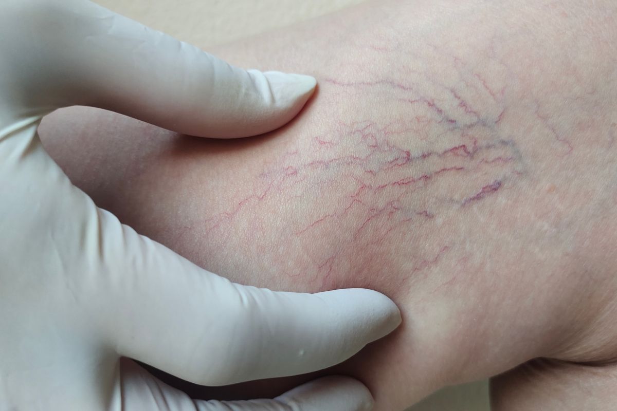 Laser transdérmico substitui a cirurgia de varizes?