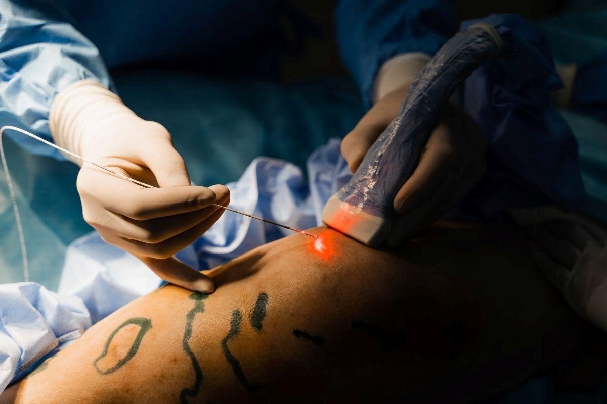 Laser vascular: como funciona e por que é tão procurado?