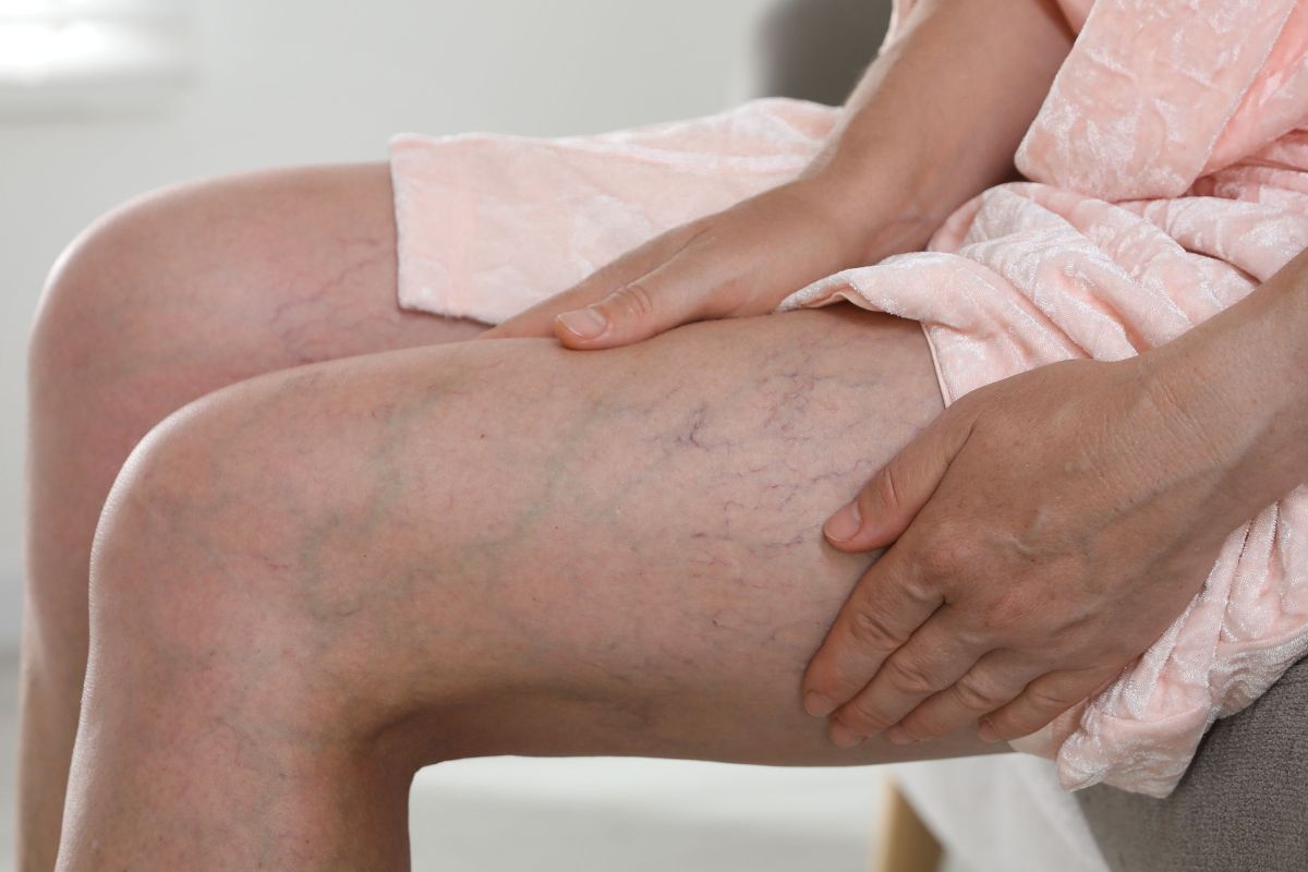 Melhor tratamento para varizes: laser, espuma ou cirurgia?