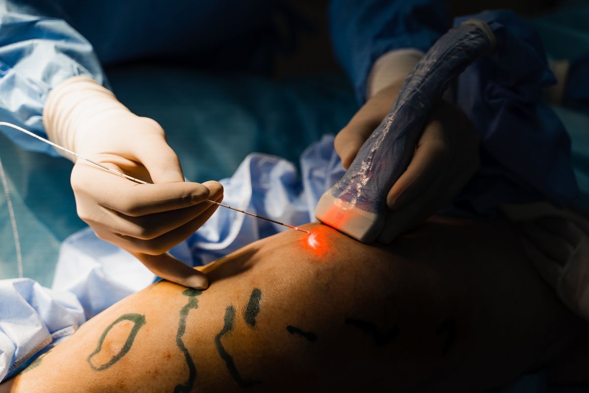 Tratamento com laser transdérmico: inovação no cuidado das varizes