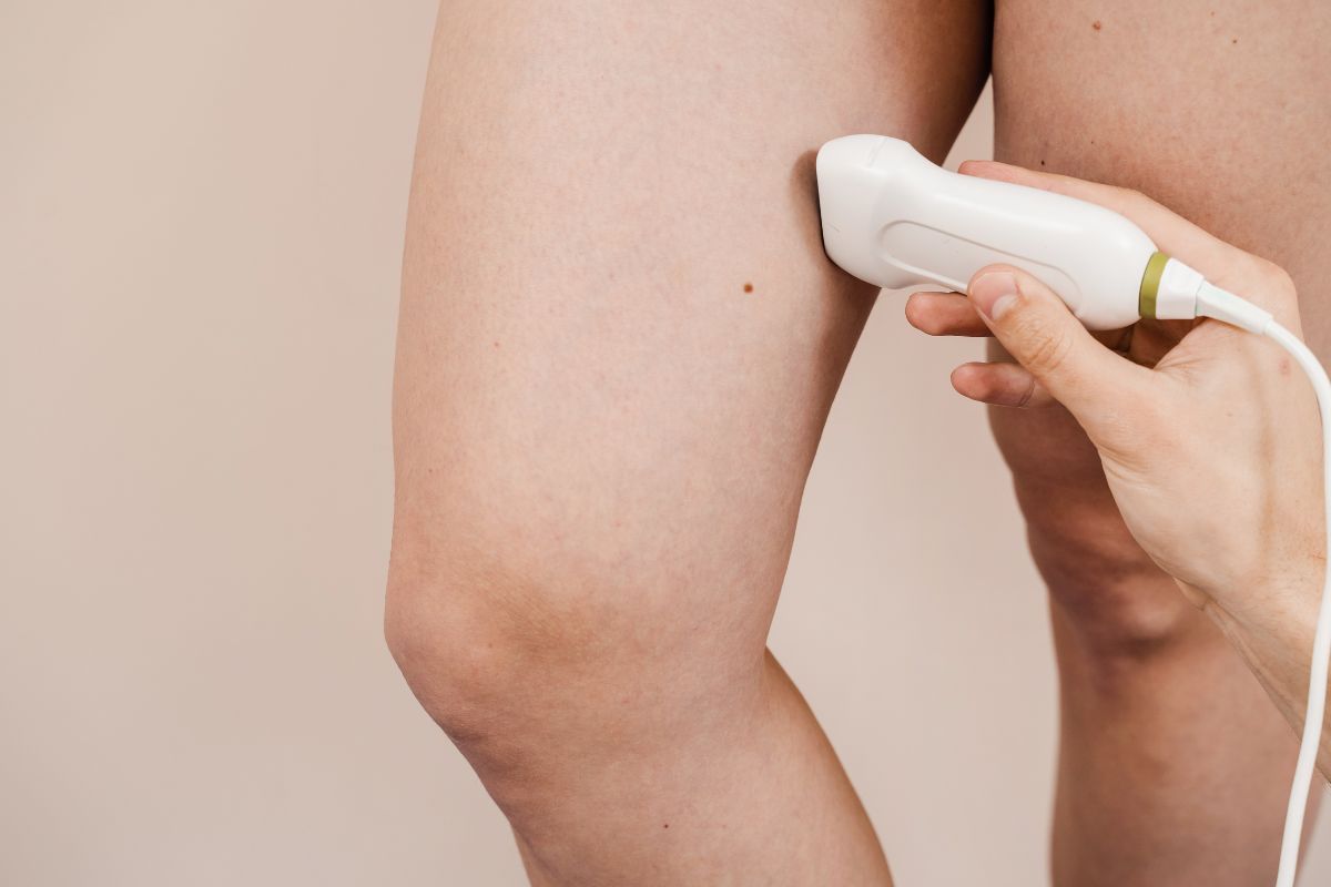 Ultrassom vascular: por que ele é essencial no diagnóstico e tratamento das varizes?