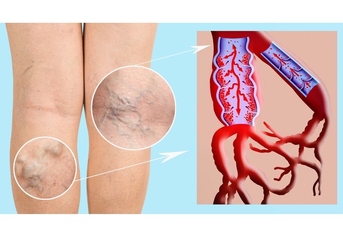 varizes-pequenas-clinica-vascullare-cirurgia-varizes-foz-iguacu