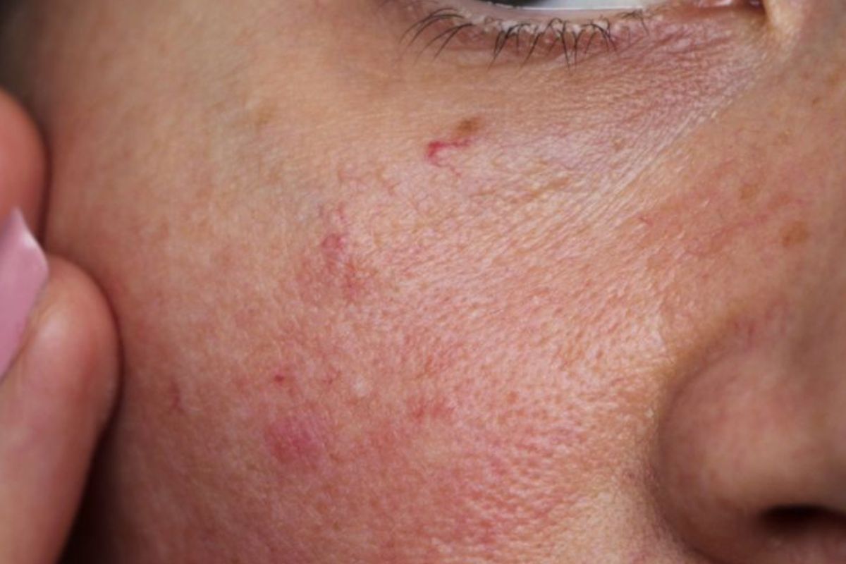 Os vasinhos no rosto estão incomodando? Saiba como o laser atua