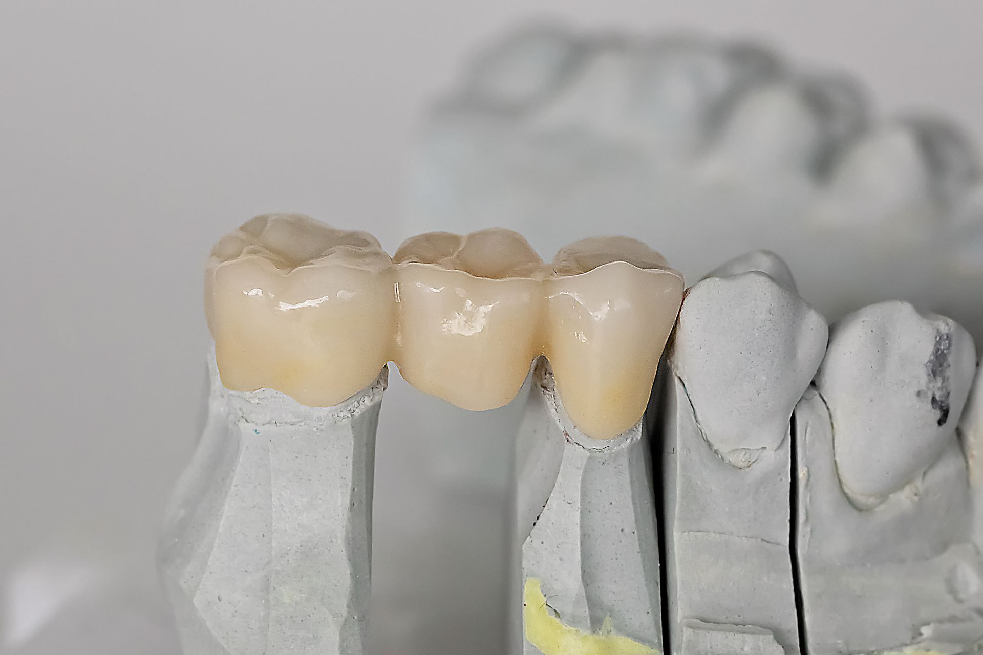 Dental bridge model displaying three connected, tooth-colored crowns, resting on a white dental cast.