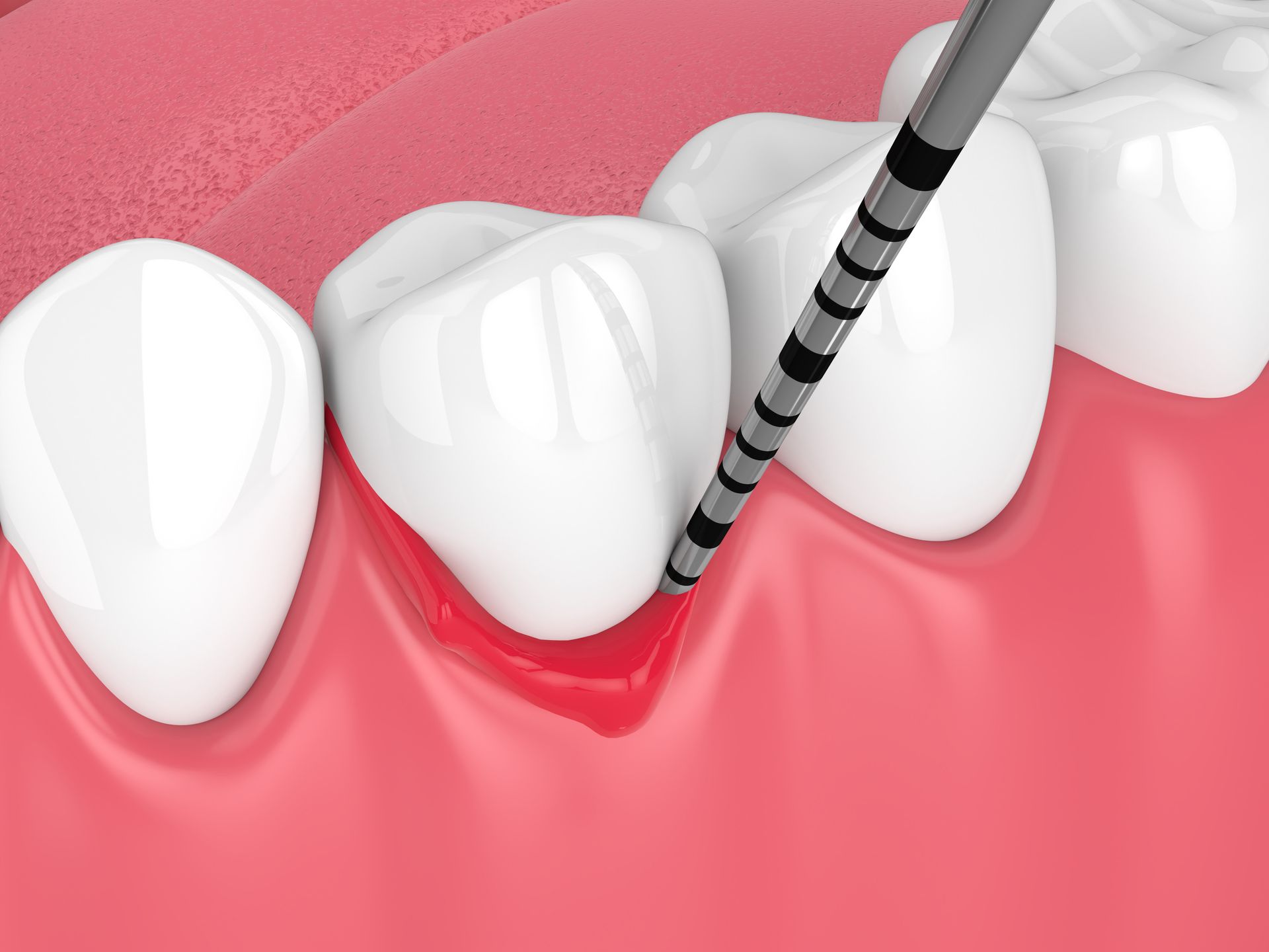 Dental probe measuring gum pocket depth around teeth. Red gums, white teeth.
