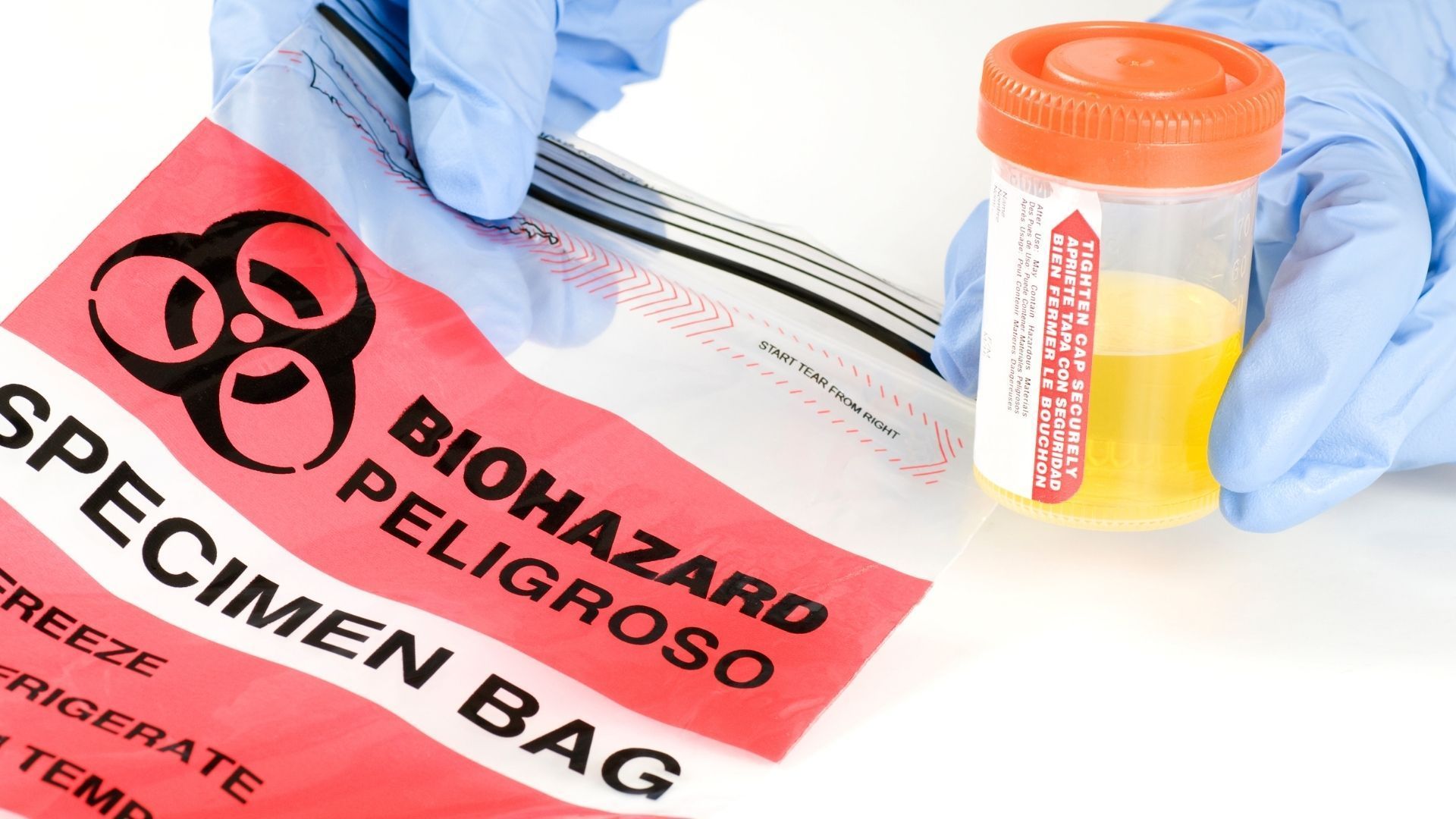 A person is holding a bottle of urine next to a biohazard specimen bag.