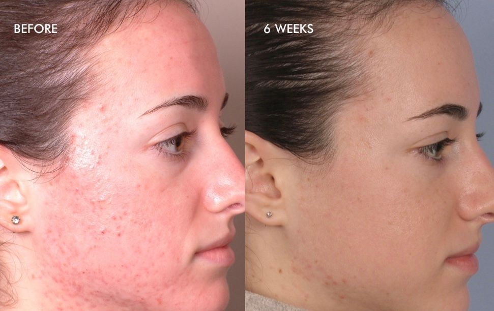 A before and after photo of a woman 's face with acne.