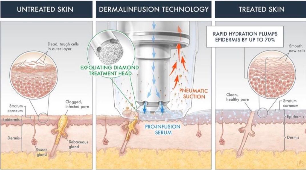Dermal Infusions | Etobicoke, ON | Skin Studio