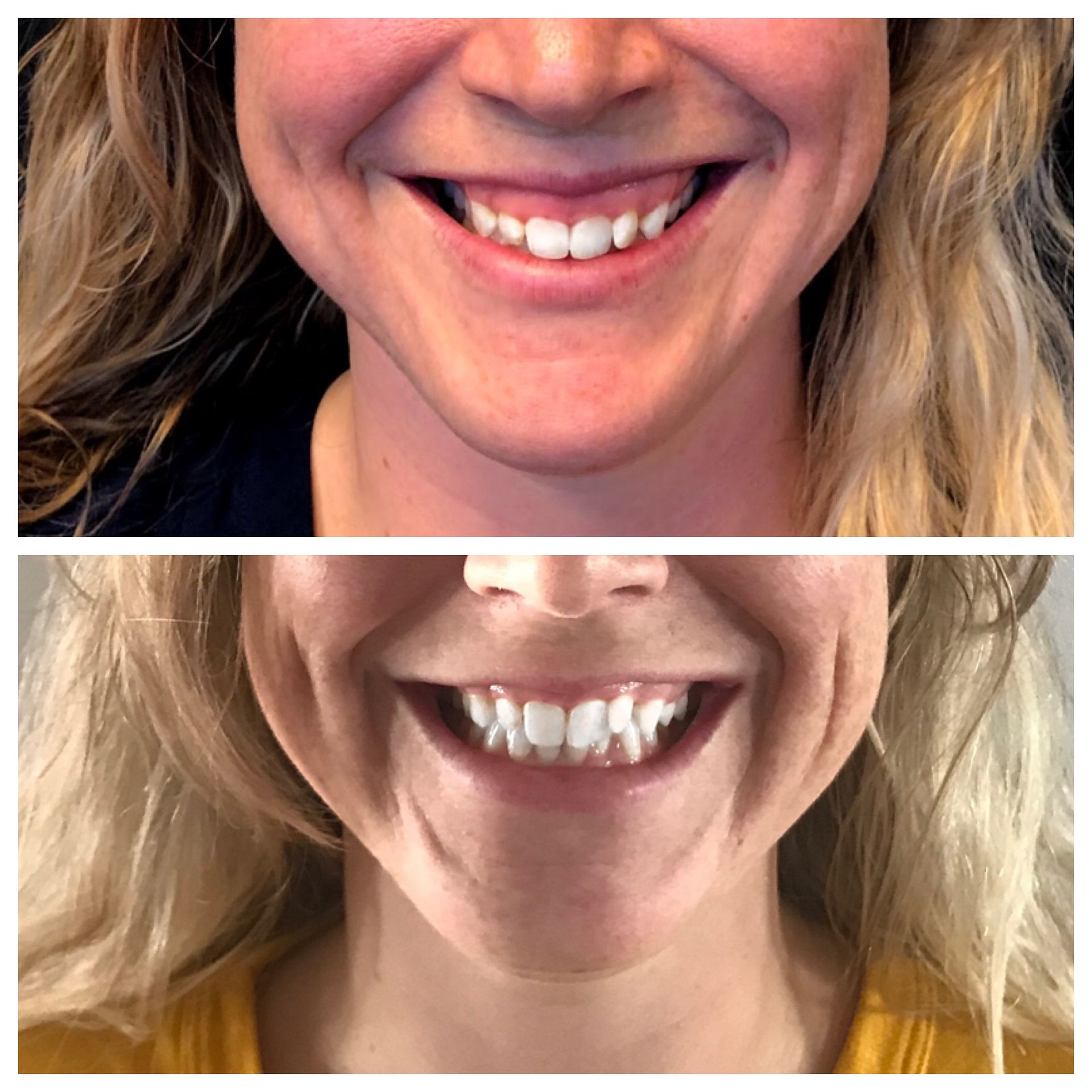 A before and after photo of a woman 's smile.