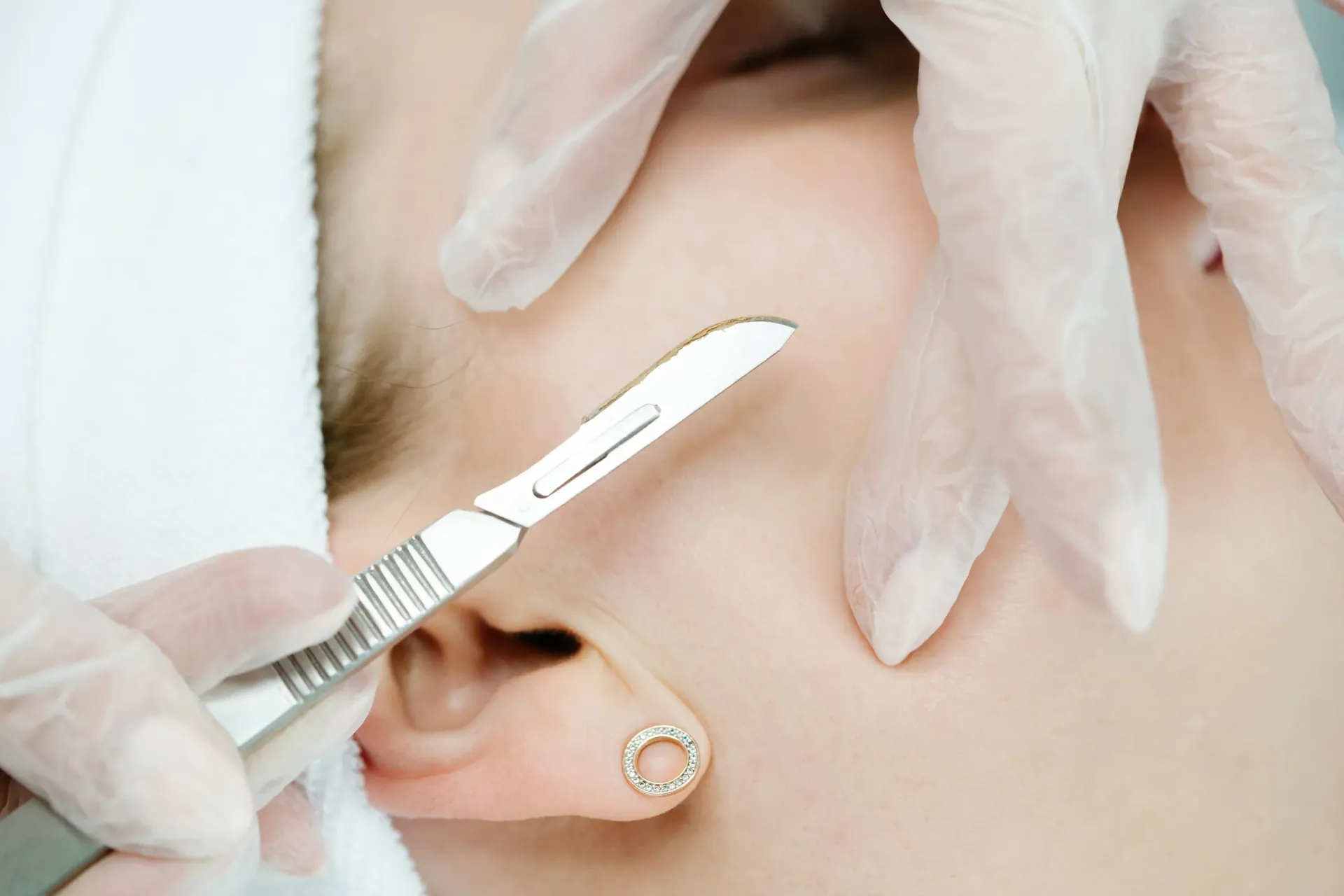 woman getting dermaplaning