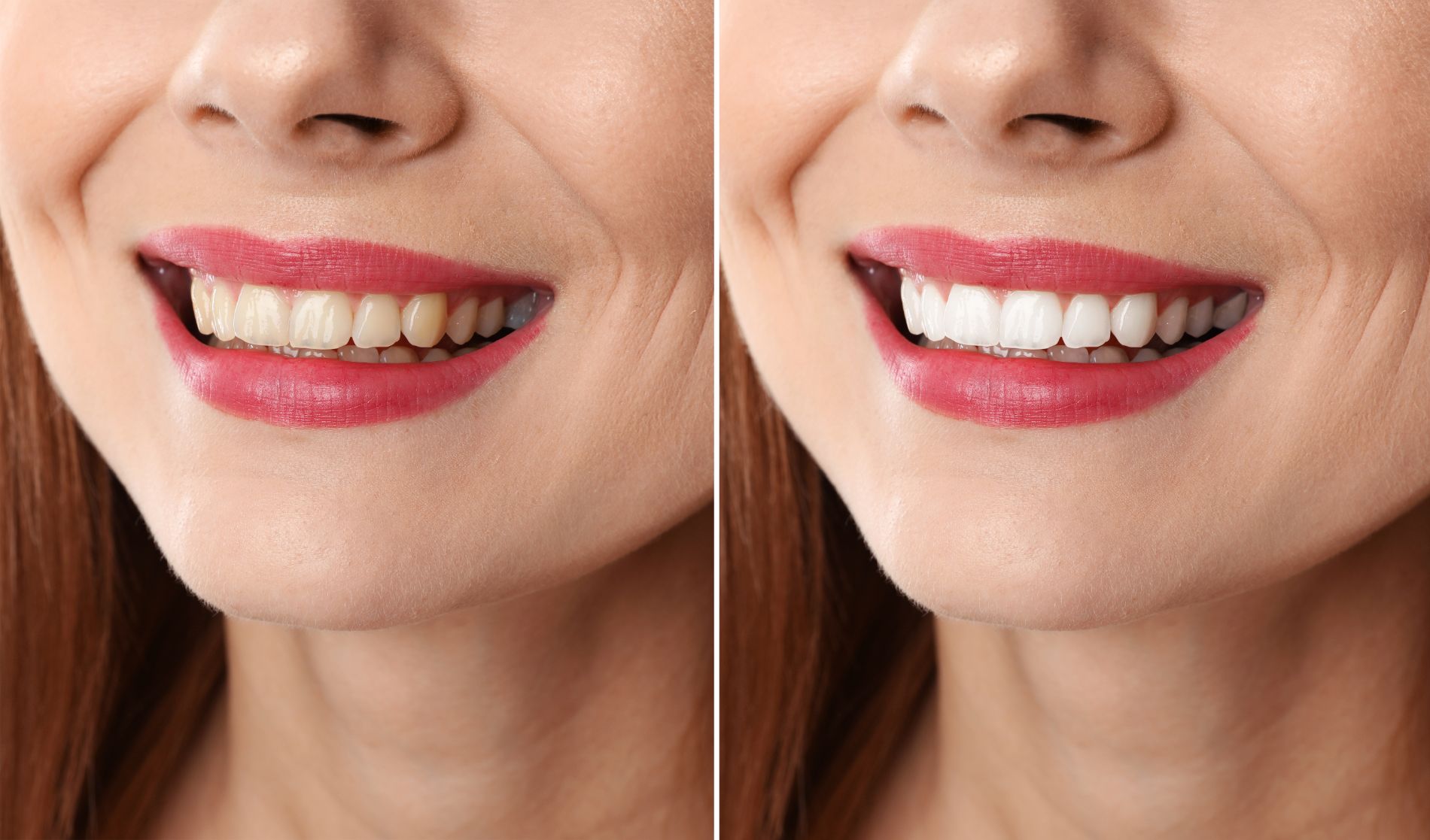 risultati sbiancamento dentale