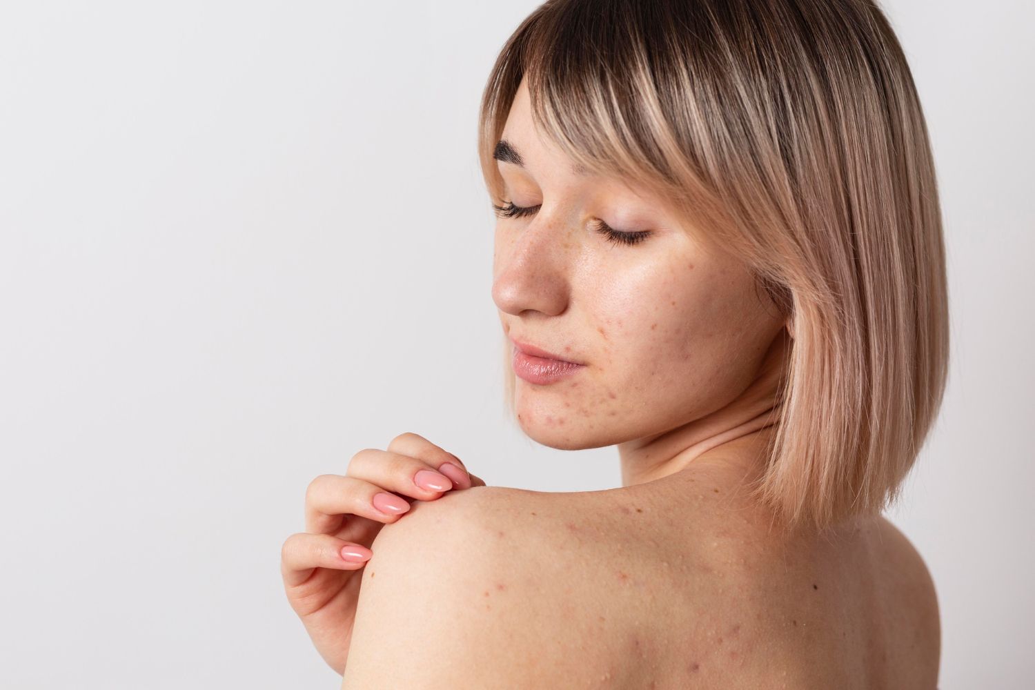 A woman with acne on her back is touching her shoulder.
