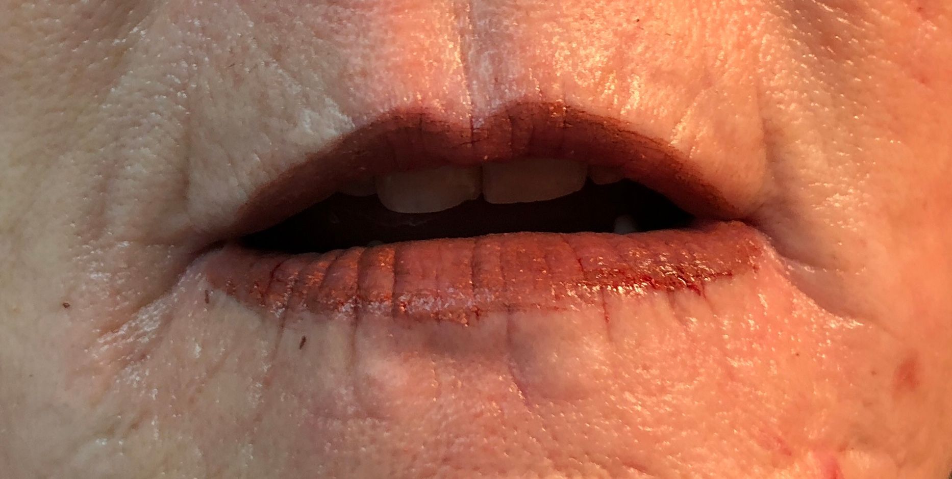 lips after procedure